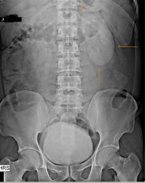 Dense Persistent Nephrogram -- Causes - Sumer's Radiology Blog