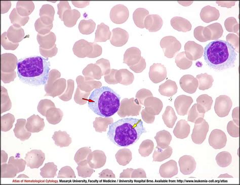 Nodal Marginal Zone Lymphoma Cell Atlas Of Haematological Cytology