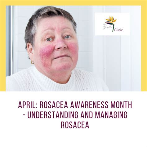 April Rosacea Awareness Month Understanding And Managing Rosacea