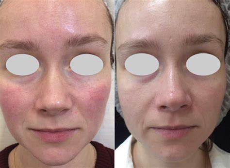 Rosacea Treatment Reduce Redness Skin Doctor Clinics