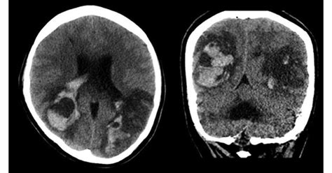 Neurology Journal On Twitter Acute Hemorrhagic Encephalitis Related