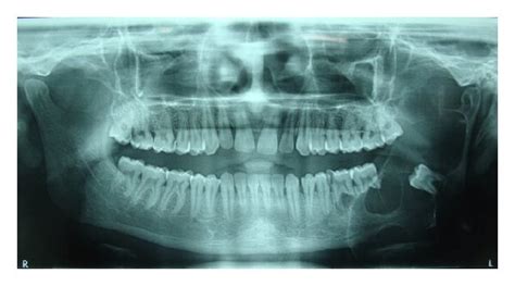 OPG Showing Multilocular Radiolucency In Relation To Left Third Molar