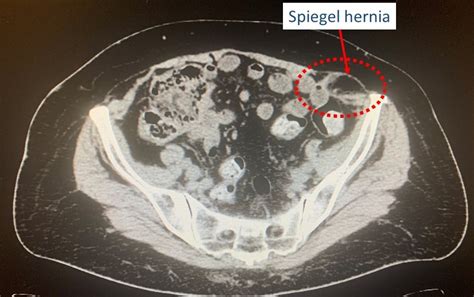 Prof. Giuseppe Amato: Spigelian hernia