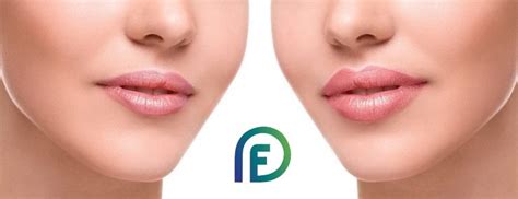 Filler lip augmentation techniques - ProfyFiller