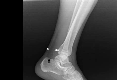 The Kager's Fat Pad Sign - Journal of Emergency Medicine