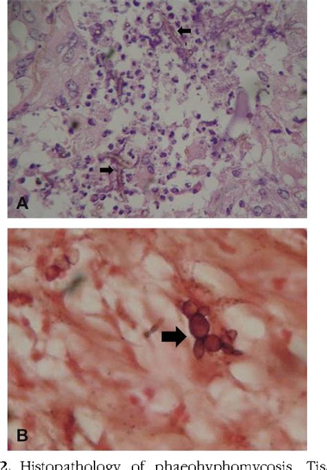 figure   treatment  subcutaneous phaeohyphomycosis