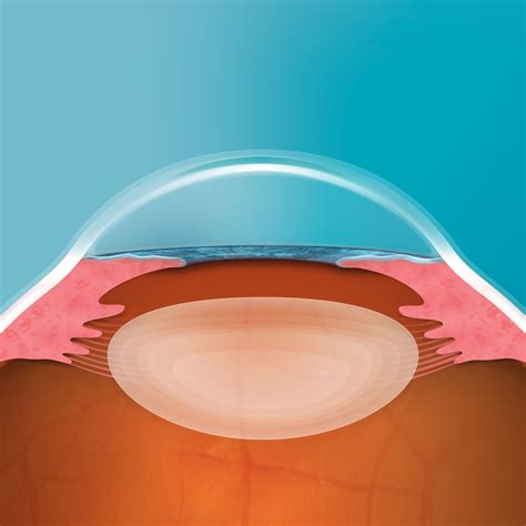 EVO ICL Surgery | Texas Eye and Cataract