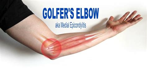 Golfers Elbow AKA Medial Epicondylitis