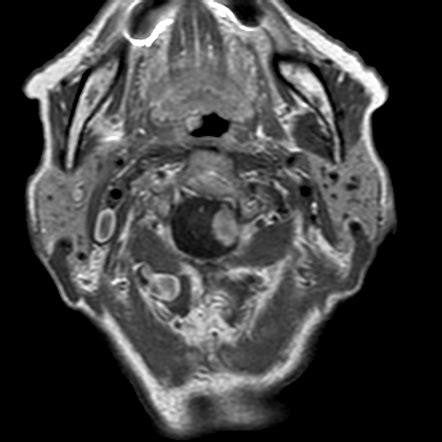 Spinal Meningioma Cervical Image Radiopaedia Org