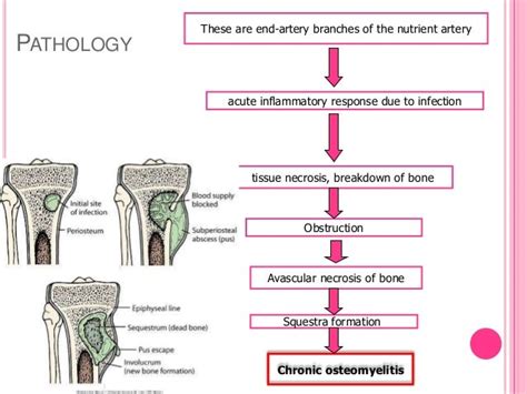 Osteomyelitis