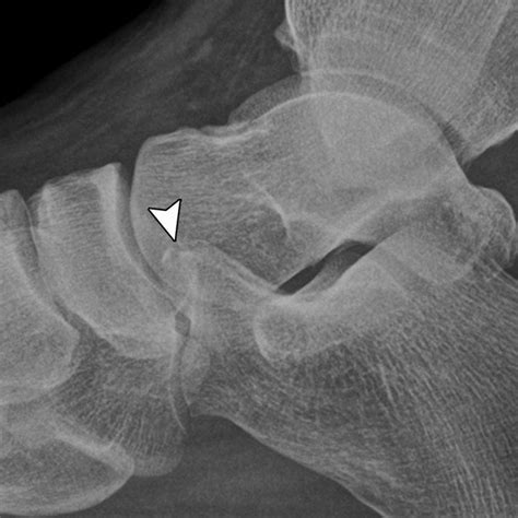 acute fracture   anterior process  calcaneus   herald