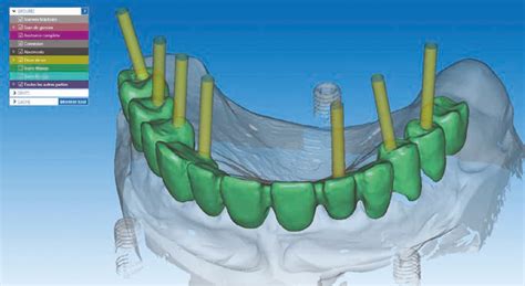 CAD/CAM for Dental Implant System REVOIS®