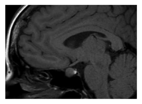 Sella Mri Images Showing Pituitary Enlargement At Presentation A B