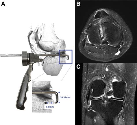 Figure 7 From Bone Trough Lateral Meniscal Allograft Transplantation