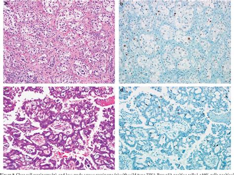 Mixed Salivary Gland Tumor Semantic Scholar