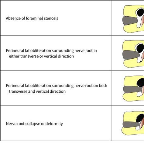 Illustration Of Neural Foraminal Stenosis Download Scientific Diagram