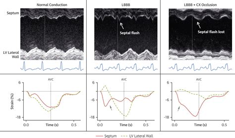 Mechanism Of Abnormal Septal Motion In Left Bundle Branch Block Role