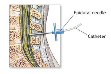 Epidural Catheter Complications - Nursing Education