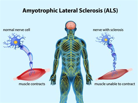 Amyotrophic Lateral Sclerosis (ALS): Understanding the Progression and ...