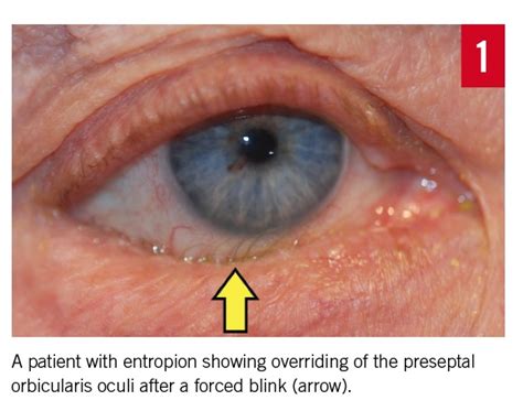 Entropion Etiology Classification Diagnosis And Treatment