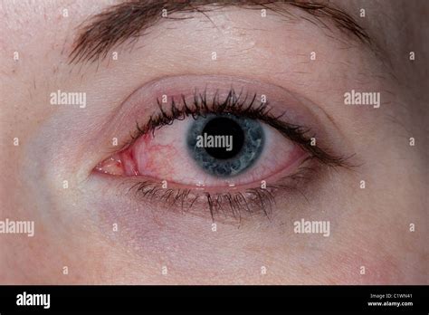 Bacterial Conjunctivitis Hi Res Stock Photography And Images Alamy