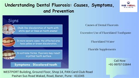 Understanding Dental Fluorosis: Symptoms, and Prevention