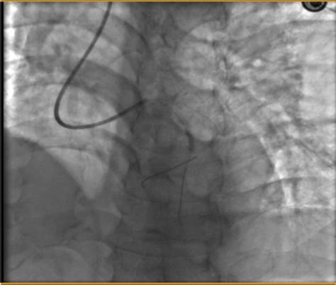 Coronary angiography results | Download Scientific Diagram