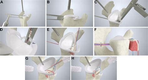 Remodeling Process And Clinical Outcomes Following All Arthroscopic Modified Eden Hybinette