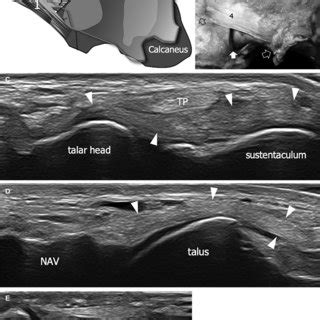 spring calcaneonavicular ligament  schematic drawing