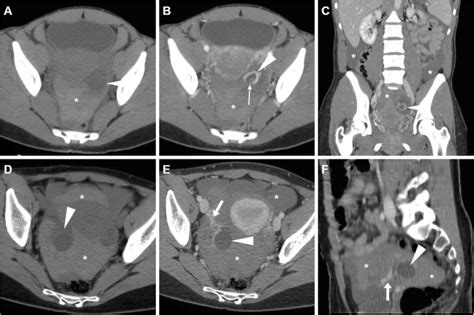 Cross Sectional Imaging Of Acute Gynaecologic Disorders Ct And Mri