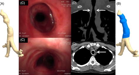 Airway Stenting Technological Advancements And Its Role In