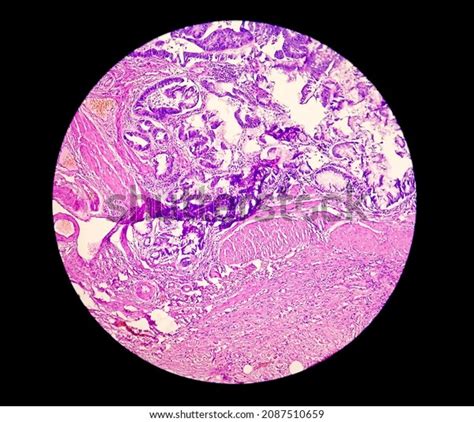 Photomicrograph Showing Adenocarcinoma Cancer Oncology Histology Stock ...