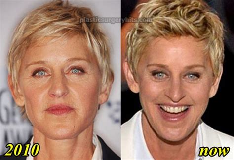 Ellen DeGeneres Plastic Surgery Before and After Facelift and Necklift