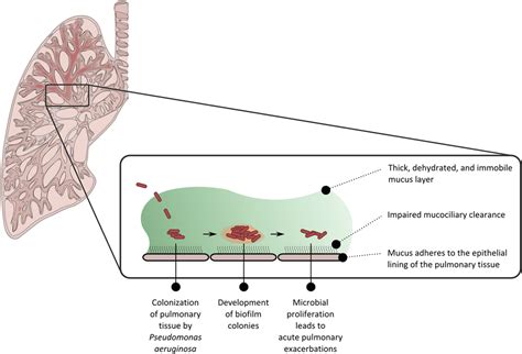 Development Of Levofloxacin Inhalation Solution To Treat Pseudomonas