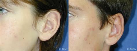 Otoplasty And Earlobe Repair Before After Gallery Patient 4