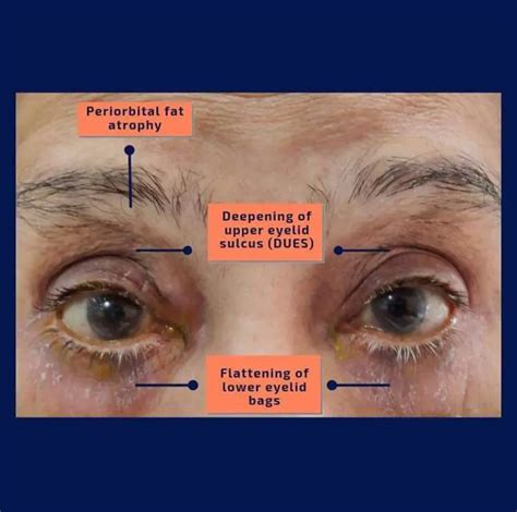 Prostaglandin Associated Periorbitopathy PAP An Eye Care Blog