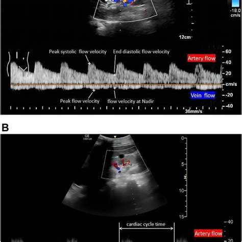 Normal Hepatic Vein Flow Pattern Detected By Doppler The Hepatic Vein