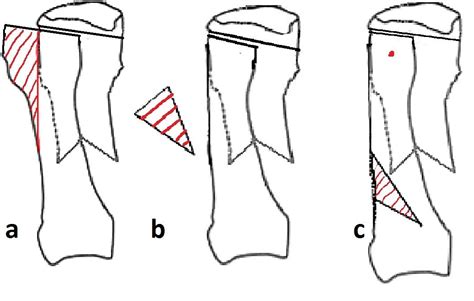 scarf osteotomy | The Foot and Ankle Online Journal