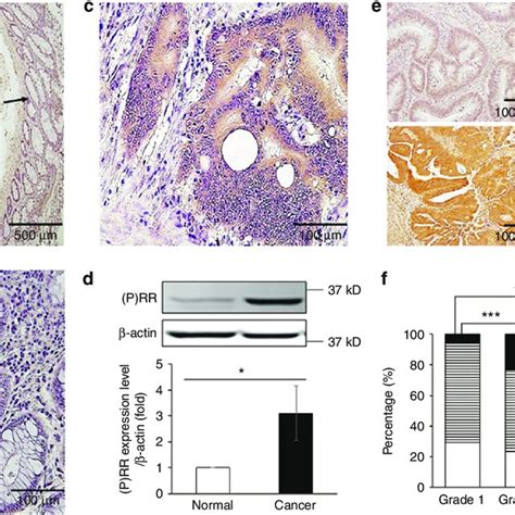 Prr Is Highly Expressed In Human Crc Tissues A Representative Image