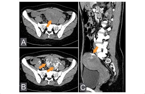 Acquired Uterine Arteriovenous Malformation Uavm Occurred In A