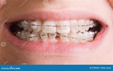 Smile With Braces Royalty Free Stock Photo - Image: 3798255