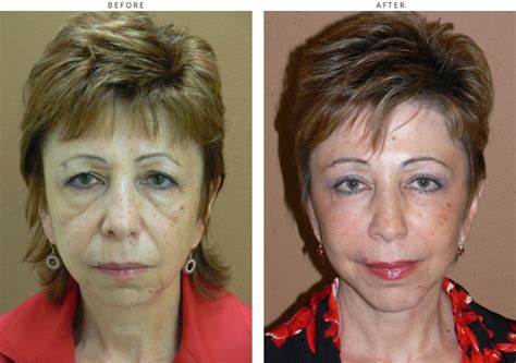 Mid Face Lift – Before and After Pictures * – Dr Turowski – Plastic ...