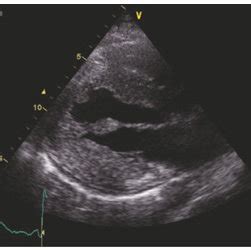 Instrumental Features Of Case Typical Echocardiographic Pattern Of