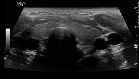 Thyroid Ultrasound Protocol Sonographic Tendencies