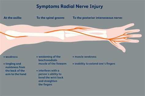 Radial Nerve Peripheral Upper Extremity El Paso S Personal Injury