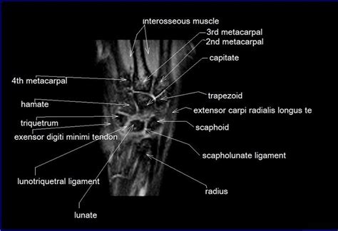 Wrist Mri Anatomy Radiology