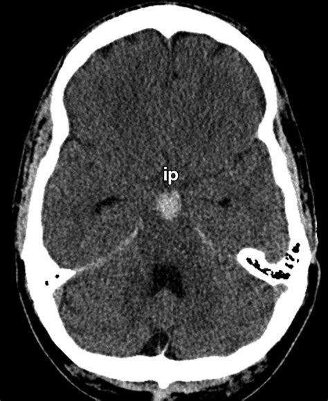 Subarachnoid Hemorrhage Beyond Aneurysms Ajr