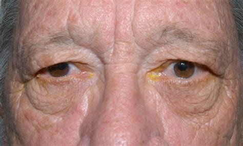 Moran Core Ptosis