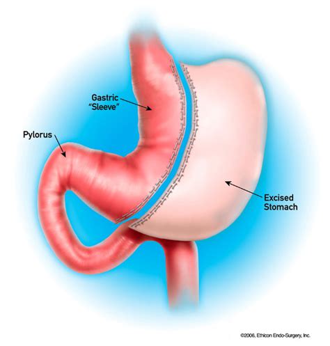 Gastric Sleeve Surgery How Can It Help With Your Weight Loss