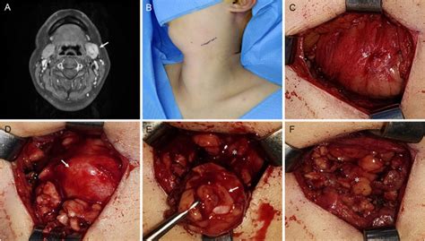 Extracapsular Dissection Versus Total Excision For Benign Submandibular